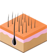 так выглядит волосяной покров до лазерной эпиляции