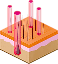 воздействие лазером на волосяной покров целевой области