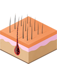 воздействие на меланин и повышение температуры фолликула