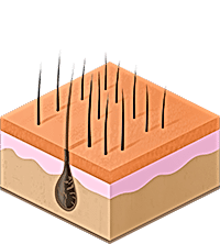 так происходит разрушение фолликула