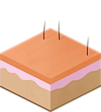 результат лазерной эпиляции на определенную область