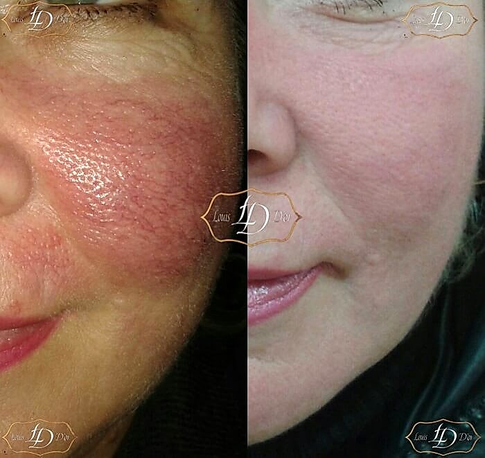 сосудистые звездочки до и после процедуры