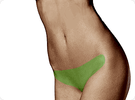 Лазерная эпиляция бикини