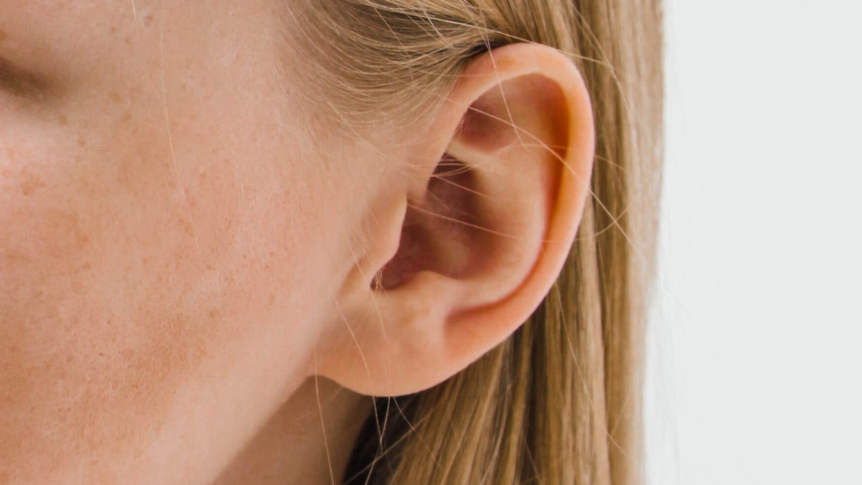 Лазерная эпиляция щек