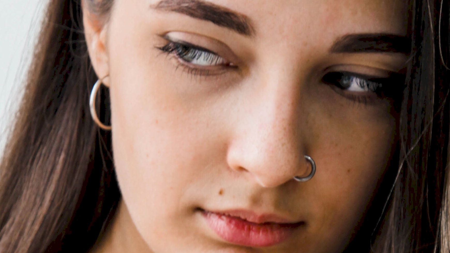 Лазерная эпиляция щек