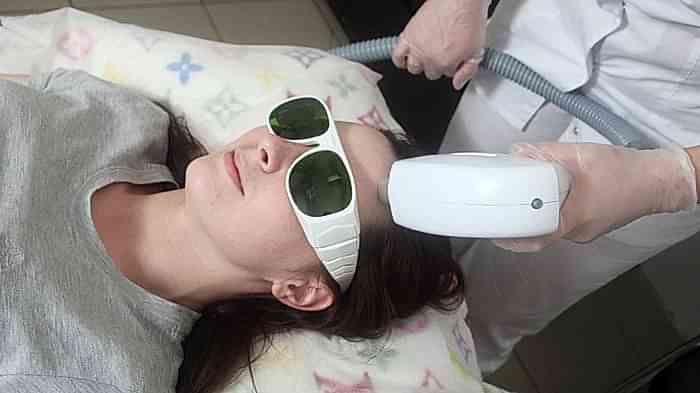 лазерная эпиляция