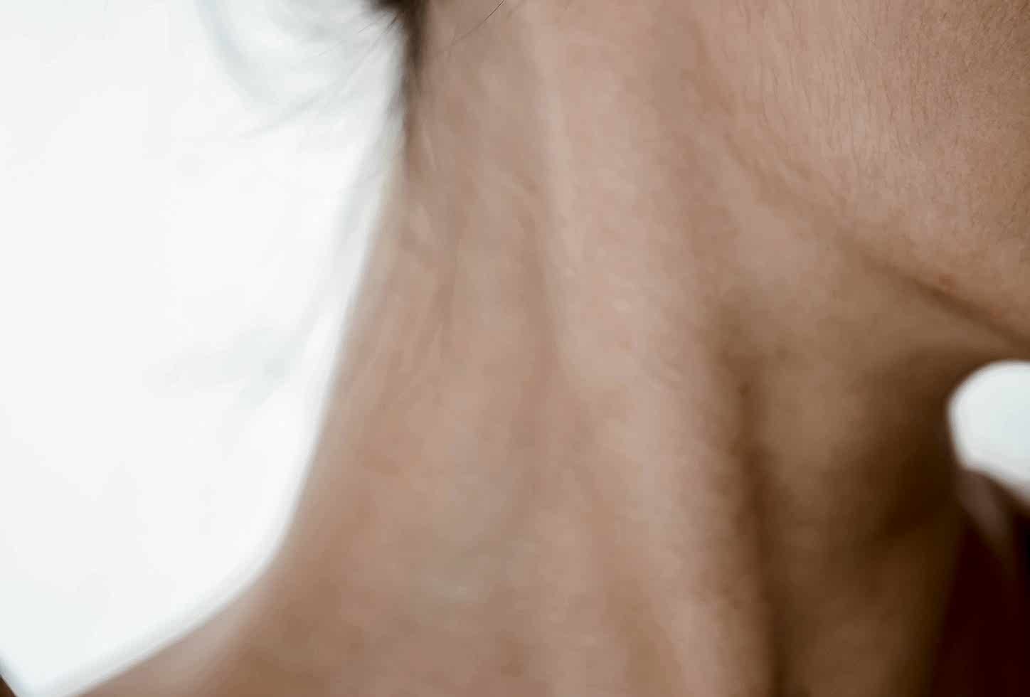 Лазерная эпиляция подбородка