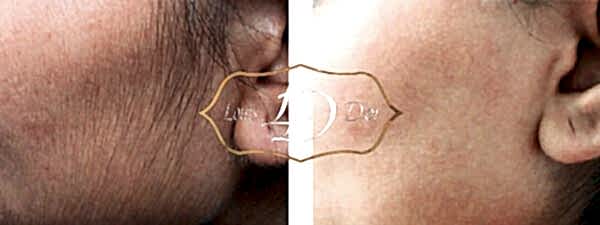 До и после лазерной эпиляции щек