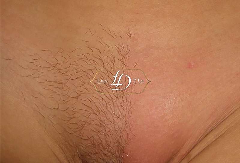 Лазерная эпиляция бикини: до и после