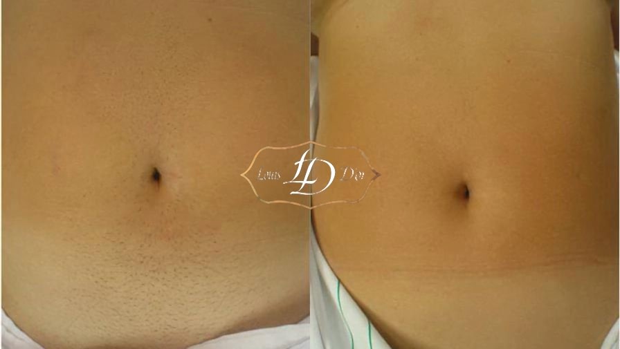 До и после лазерной эпиляции живота