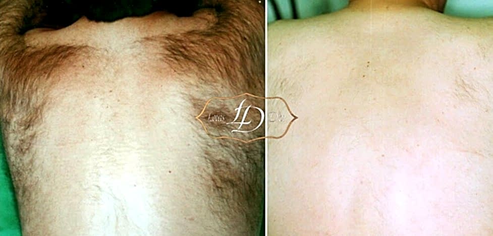 До и после лазерной эпиляции плеч