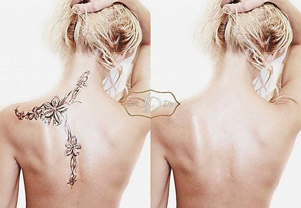 Удаляем татуировки неодимовым лазером: эффект после курса процедур