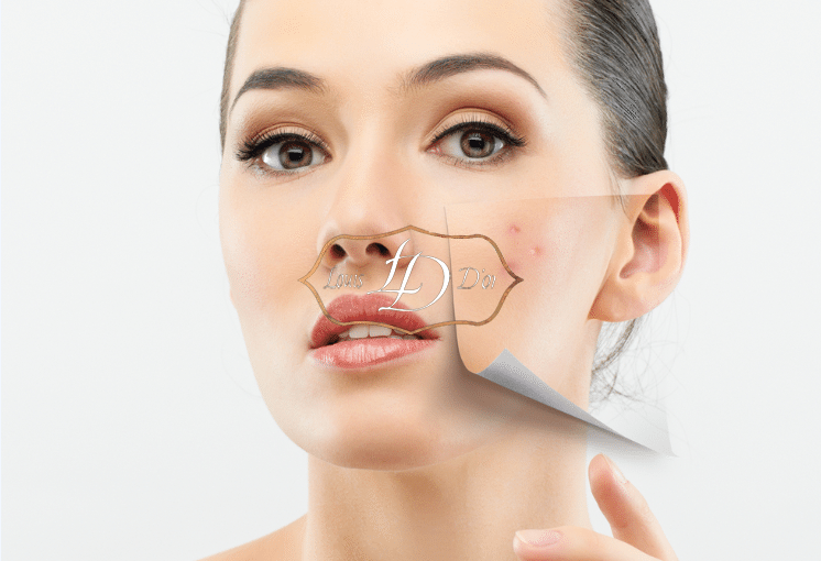 Когда лечение акне на лице лазером эффективно?