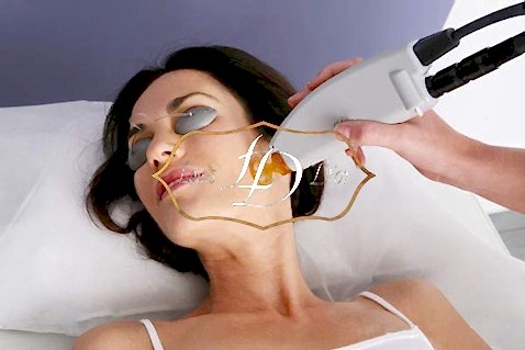 Процедура лечения прыщей лазером