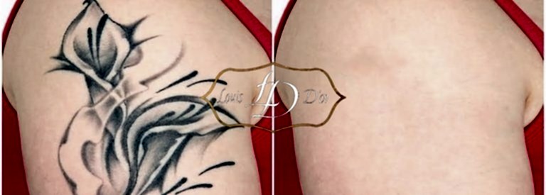 Удаление татуировок лазером