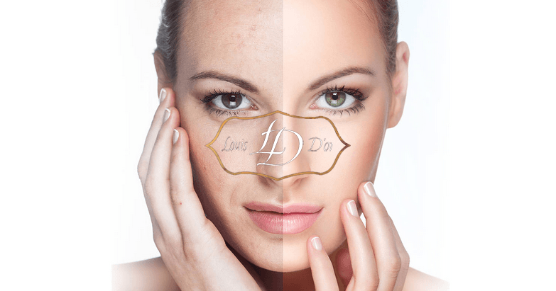 Эффект фракционного лазерного омоложения