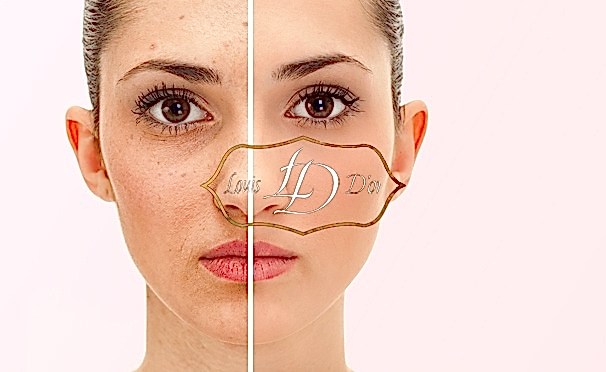 Избавление от сосудистой сеточки и пигментных пятен с помощью ЭЛОС