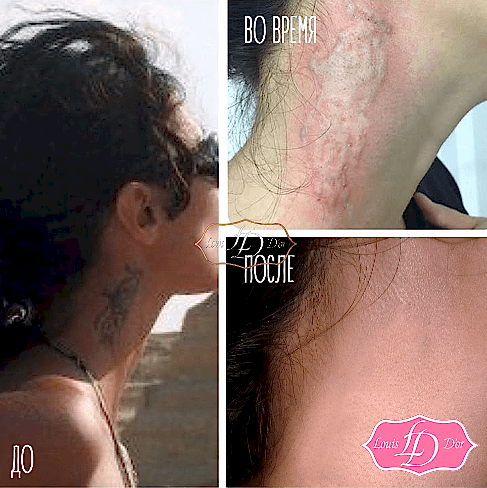 Удаление наколки на пальцах лазером