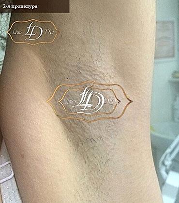 подмышка после 1го сеанса лазерной эпиляции