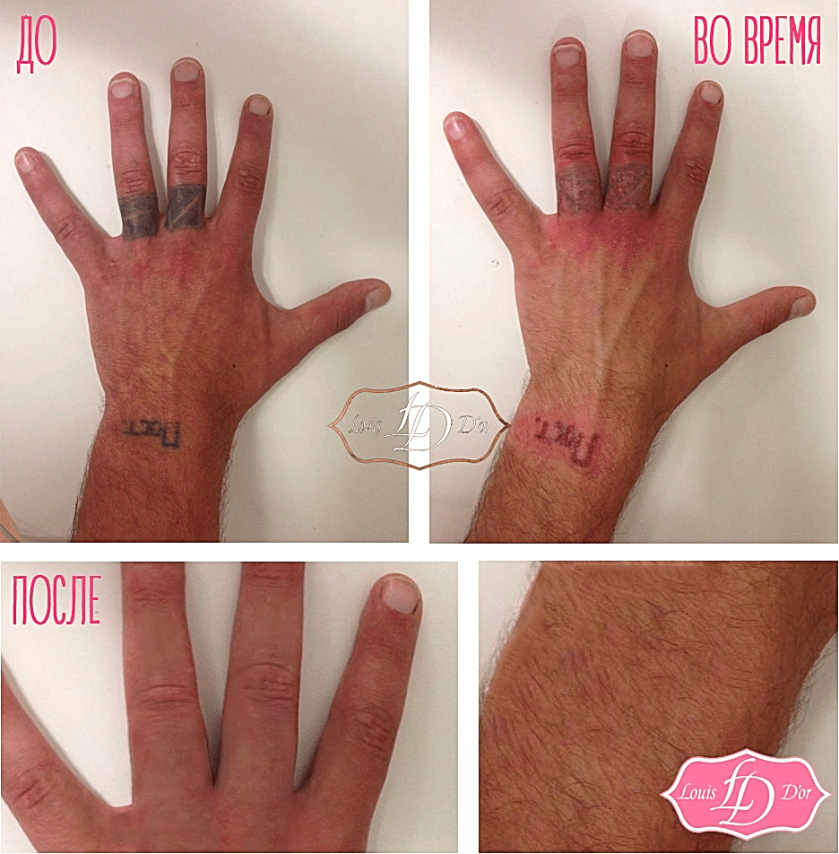 Сведение одноцветной татуировки на шее