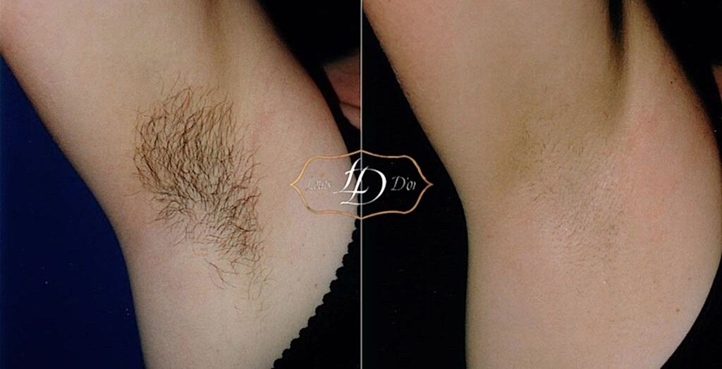 До и после лазерной эпиляции подмышек