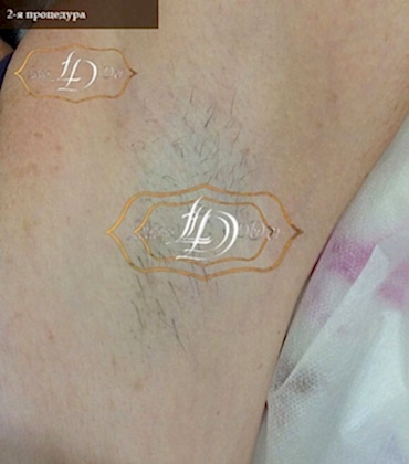 подмышка после 2го сеанса лазерной эпиляции