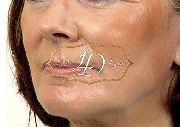 Фото после лазерного фракционного омоложения