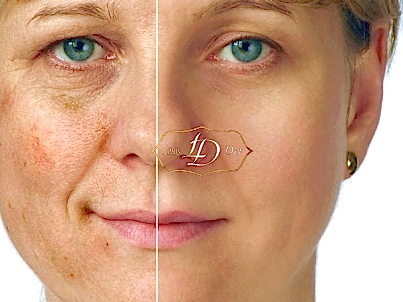 Удаление пигментных пятен на лице лазером: до и после