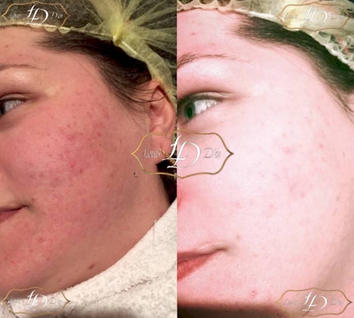 анти-акне до и после процедуры