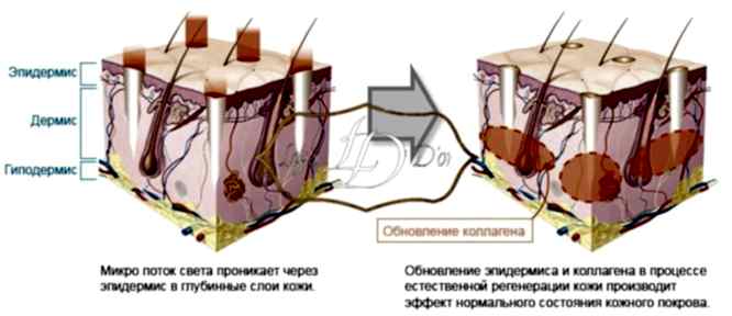 Суть метода фракционного лазерного омоложения