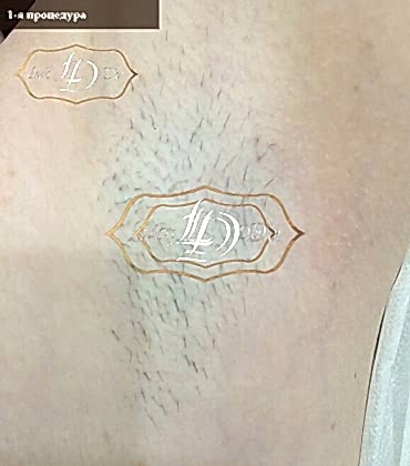 подмышка после 1го сеанса лазерной эпиляции