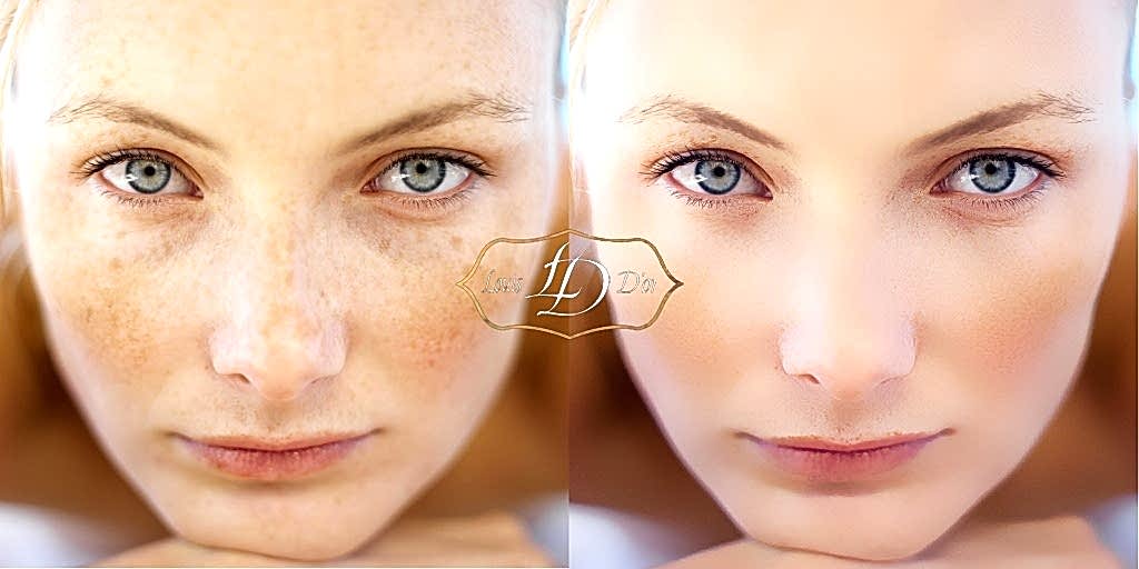 Удаление пигментных пятен лазером - способ избавиться от веснушек