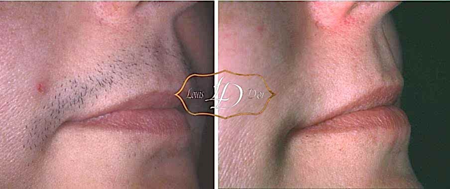 До и после лазерной эпиляции верхней губы До и после лазерной эпиляции верхней губы