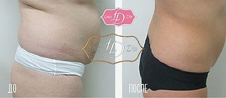 Ролико-вакуумный массаж до и после