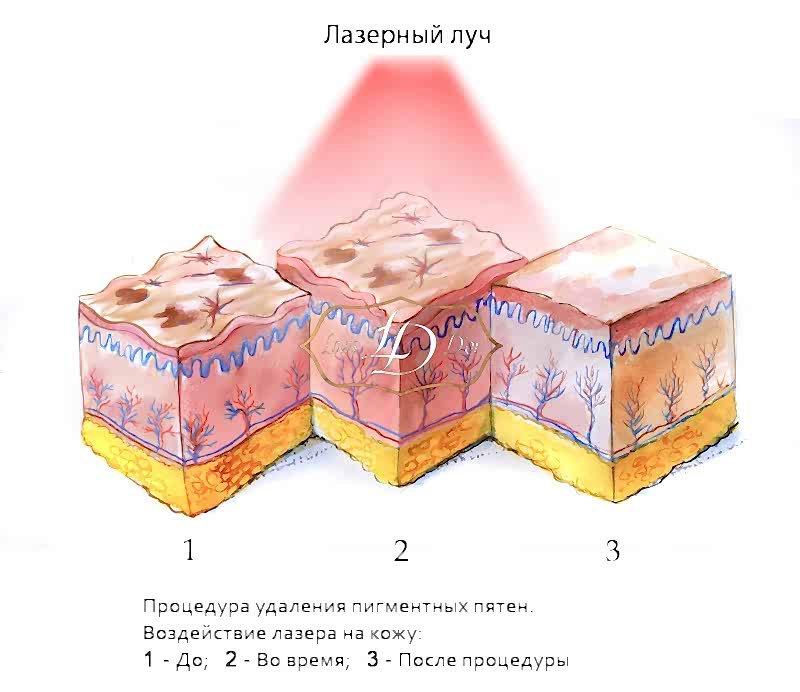 Этапы удаления пигментного пятна лазером
