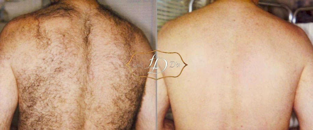 До и после лазерной эпиляции спины