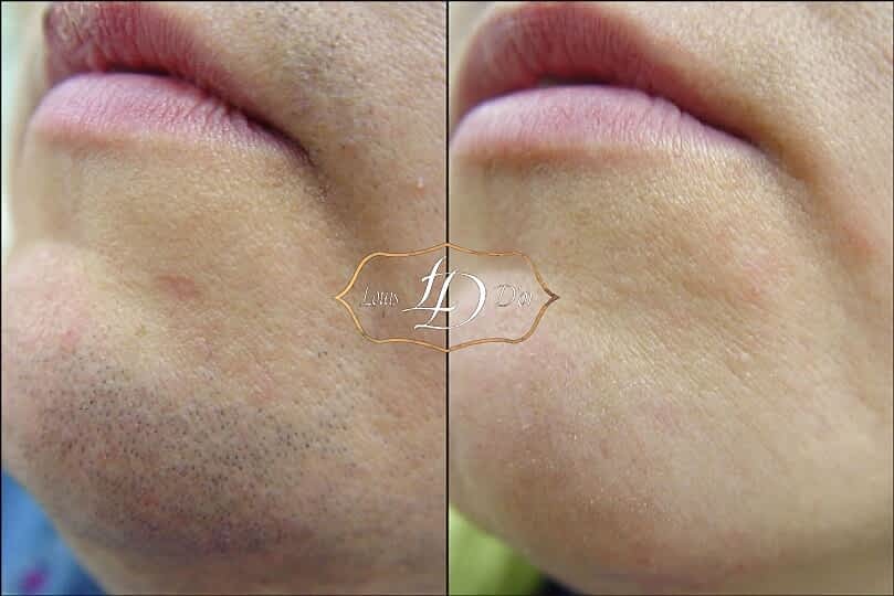 До и после лазерной эпиляции подбородка