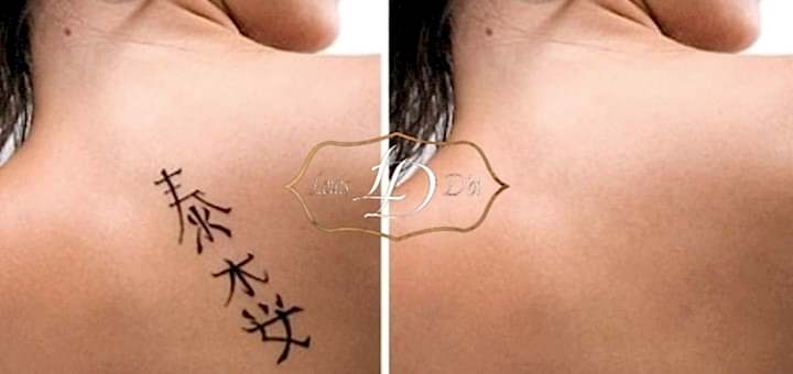 Удаление тату лазером