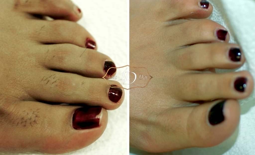 До и после лазерной эпиляции пальцев ног До и после лазерной эпиляции пальцев ног