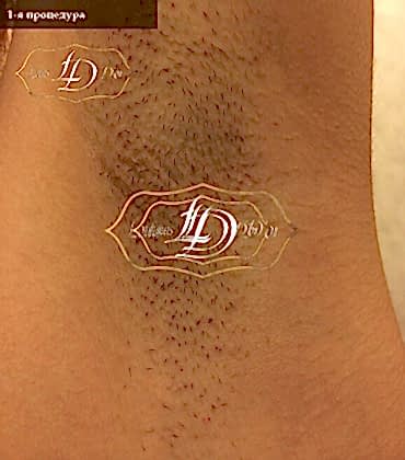 подмышка после 1го сеанса лазерной эпиляции