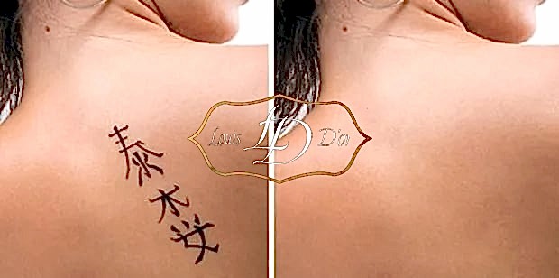 Эффективность лазерного удаления татуировки