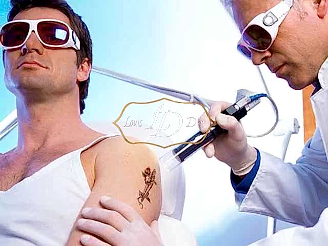 Как проходит лазерное удаление татуировки