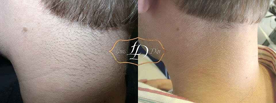 До и после лазерной эпиляции шеи