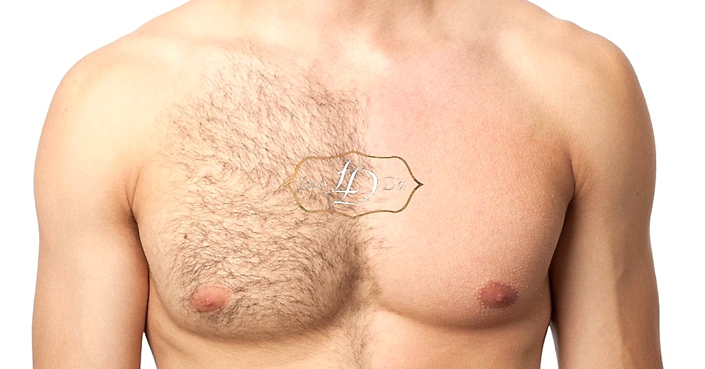 До и после лазерной эпиляции груди