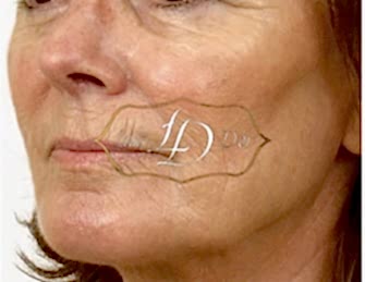 Фото до лазерного фракционного омоложения кожи