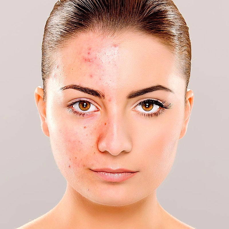 элос лечение акне