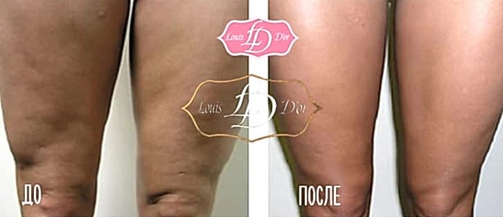 Ролико-вакуумный массаж до и после