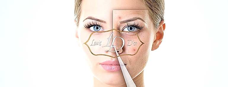 При акне рекомендуется лечение прыщей лазером