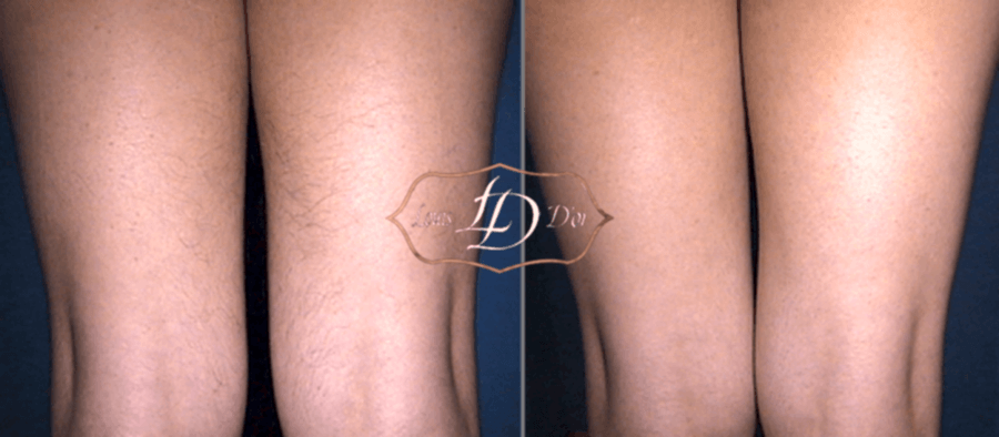 До и после лазерной эпиляции ног До и после лазерной эпиляции ног