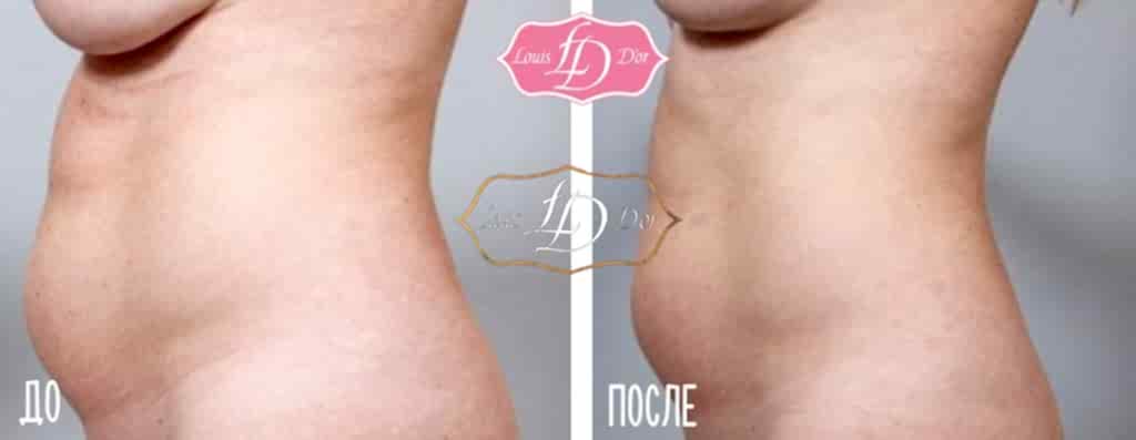 Ролико-вакуумный массаж до и после